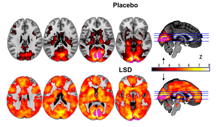 Store områder av hjernen lyste opp på hjerneskanninger (nederst) når forsøkspersonene fikk LSD. Øverst er normale hjerneskann fra forsøkspersoner som bare fikk luremedisin, placebo. Begge grupper lukket øynene under forsøkene. (Foto: (Figur: Imperial College London/Robin Carhart-Harris)) Store områder av hjernen lyste opp på hjerneskanninger (nederst) når forsøkspersonene fikk LSD. Øverst er normale hjerneskann fra forsøkspersoner som bare fikk luremedisin, placebo. Begge grupper lukket øynene under forsøkene. (Foto: (Figur: Imperial College London/Robin Carhart-Harris))