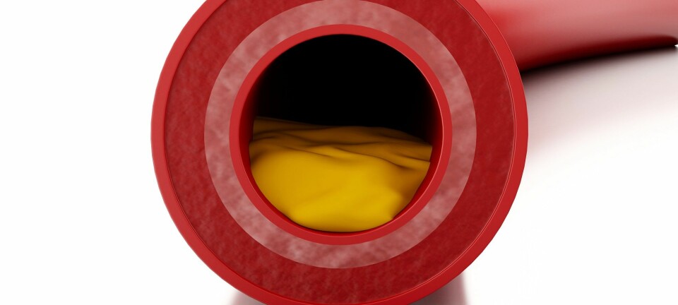 Kolesterol-plakk i blodåre. (Illustrasjon: Colourbox)