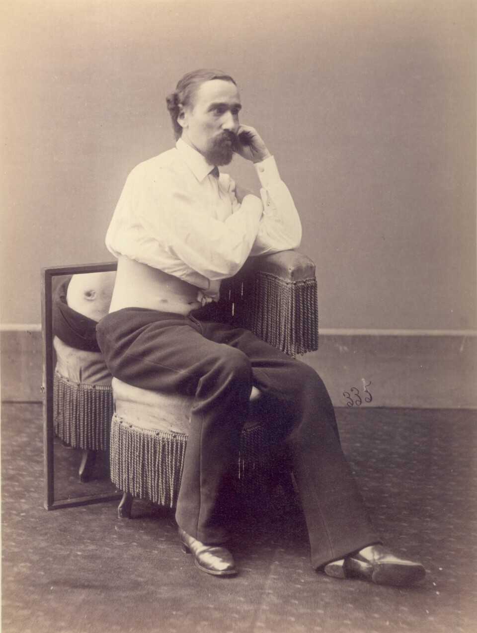 Sersjant L. Morell, skadet av skudd i 1863. (Foto: Otis Historical Archives, National Museum of Health and Medicine)
