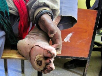 The leprosy bacterium destroys nerve cells, which means that patients may develop large ugly wounds without feeling pain. This man has developed this kind of secondary wound under his foot. (Photo: Signe Ringertz) The leprosy bacterium destroys nerve cells, which means that patients may develop large ugly wounds without feeling pain. This man has developed this kind of secondary wound under his foot. (Photo: Signe Ringertz)