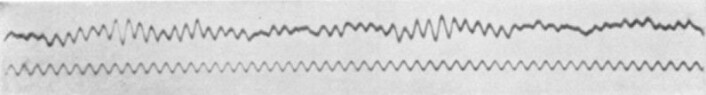Dette er en av de første målingene med EEG som ble gjennomført av den tyske nevrologen Hans Berger. (Foto: Berger H. Über das Elektrenkephalogramm des Menchen. Archives für Psychiatrie. 1929/Wikimedia commons.) Dette er en av de første målingene med EEG som ble gjennomført av den tyske nevrologen Hans Berger. (Foto: Berger H. Über das Elektrenkephalogramm des Menchen. Archives für Psychiatrie. 1929/Wikimedia commons.)