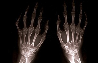 New-onset MS patients have low bone density