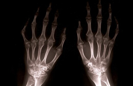 New-onset MS patients have low bone density