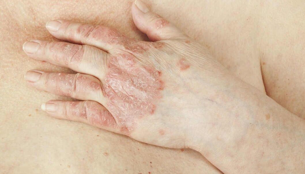 Ved å kombinere data fra 84 000 europeere kunne forskerne peke ut 244 steder i arvematerialet som er knyttet til fem autoimmune sykdommer: Crohns, PSC, Ulcerøs kolitt, psoriasis og Bekhterevs sykdom. (Foto: Shutterstock, NTB Scanpix) Ved å kombinere data fra 84 000 europeere kunne forskerne peke ut 244 steder i arvematerialet som er knyttet til fem autoimmune sykdommer: Crohns, PSC, Ulcerøs kolitt, psoriasis og Bekhterevs sykdom. (Foto: Shutterstock, NTB Scanpix)
