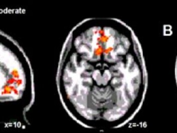 When a sense of relief turned pain into pleasure, researchers found activity in the middle of the frontal lobes of the brain, areas normally associated with comfort and the relative value of a specific experience (Image A). At the same time, they witnessed a change in activity in the same region of the brain stem that regulates pain, for example, when morphine is administered in medical treatment (Image B). When a sense of relief turned pain into pleasure, researchers found activity in the middle of the frontal lobes of the brain, areas normally associated with comfort and the relative value of a specific experience (Image A). At the same time, they witnessed a change in activity in the same region of the brain stem that regulates pain, for example, when morphine is administered in medical treatment (Image B).