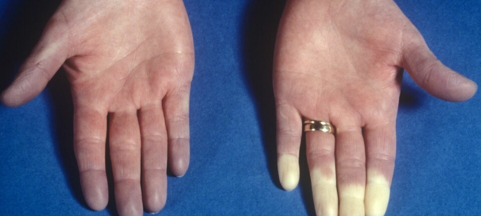 Ved Raynauds fenomen vil fingertemperaturen raskt synke fordi blodforsyningen til fingrene blir redusert når det blir kaldt. (Foto: Science Photo Library/NTB scanpix)