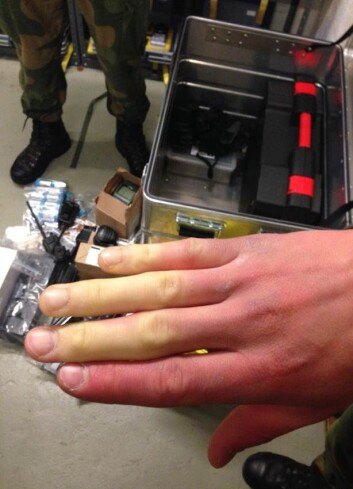 Et eksempel på hvordan Raynauds fenomen ser ut. (Foto: Forsvaret) Et eksempel på hvordan Raynauds fenomen ser ut. (Foto: Forsvaret)