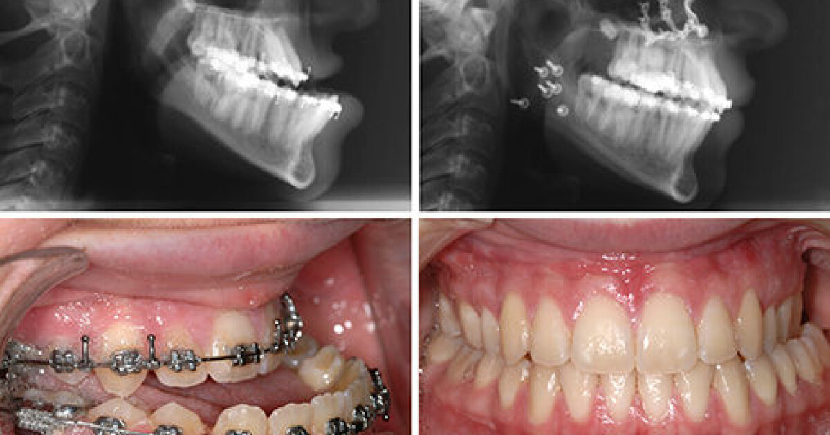 Låst kjeve Låst kjeve