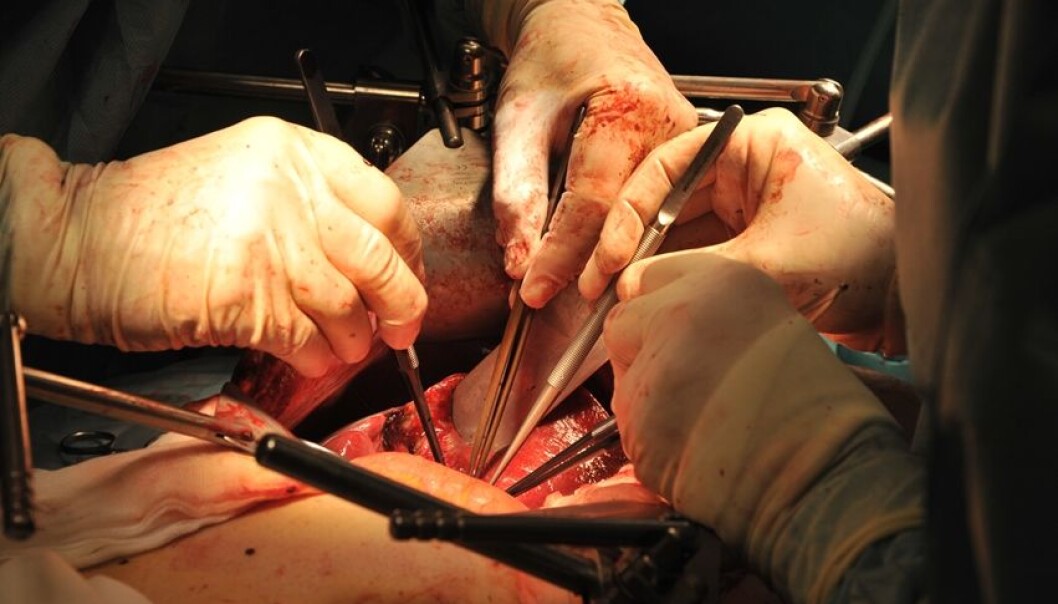 A damaged liver is replaced with a healthy one. PSC has for many years been the most common reason for liver transplants in Norway. (Photo: Ram Gupta, Oslo University Hospital) A damaged liver is replaced with a healthy one. PSC has for many years been the most common reason for liver transplants in Norway. (Photo: Ram Gupta, Oslo University Hospital)