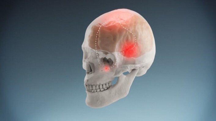 Under et migreneanfall oppstår en refleksbue der nerveknuten sphenopalatin ganglion, SPG og flere deler av hjernen er involvert. (Foto: Grafikk: Mograf.) Under et migreneanfall oppstår en refleksbue der nerveknuten sphenopalatin ganglion, SPG og flere deler av hjernen er involvert. (Foto: Grafikk: Mograf.)