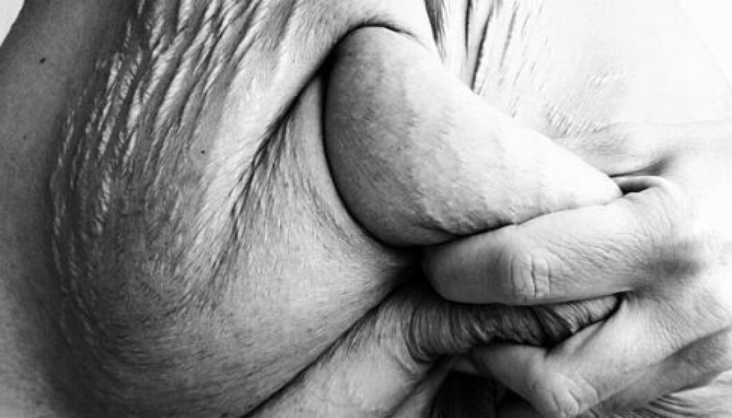 Obesity surgery results in rapid weight loss, but comes at a cost. Skin that has been pulled and stretched for years is left behind – in abundance. (Photo: Tine Dyrkorn) Obesity surgery results in rapid weight loss, but comes at a cost. Skin that has been pulled and stretched for years is left behind – in abundance. (Photo: Tine Dyrkorn)