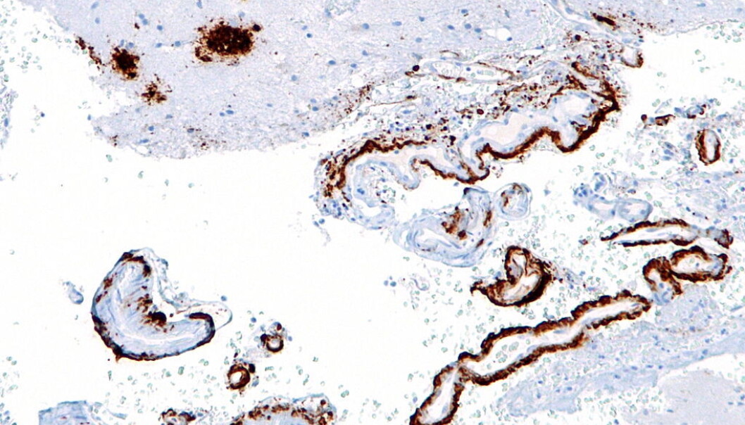 Et mikroskopbilde av opphopninger av amyloid-beta protein i hjernen. Denne opphopingen finner man ofte igjen hos pasienter med Alzheimers. (Foto: Nephron/Wikimedia Commons.) Et mikroskopbilde av opphopninger av amyloid-beta protein i hjernen. Denne opphopingen finner man ofte igjen hos pasienter med Alzheimers. (Foto: Nephron/Wikimedia Commons.)