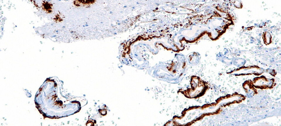 Et mikroskopbilde av opphopninger av amyloid-beta protein i hjernen. Denne opphopingen finner man ofte igjen hos pasienter med Alzheimers.  (Foto: Nephron/Wikimedia Commons.)