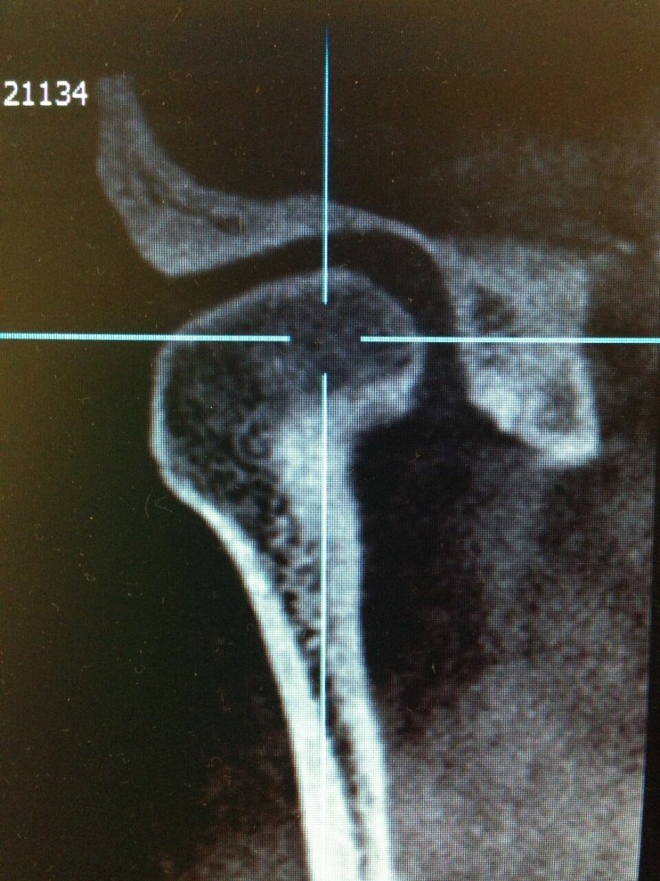 Røntgenbilde av kjeveledd, forfra. Det er i hulrommet mellom leddet og skallen at leddvæsken befinner seg.  (Foto: Heming Olsen-Bergem, Det odontologiske fakultet/UiO)