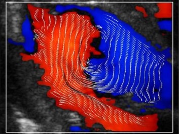 The pattern and direction of blood flow in the heart is very clearly visible with the new technology. (Photo: NTNU) The pattern and direction of blood flow in the heart is very clearly visible with the new technology. (Photo: NTNU)