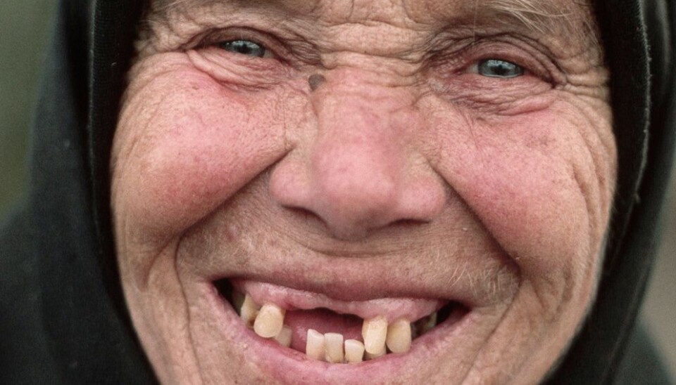Verdens helseorganisasjon har som mål at eldre over 80 år i Europa skal ha beholdt 20 tenner. Dette er ikke oppfylt i mange land. Denne kvinnen fra Romania er en av dem som kanskje ikke har så mange tenner i behold. (Foto: Barry Lewis, Corbis/scanpix)