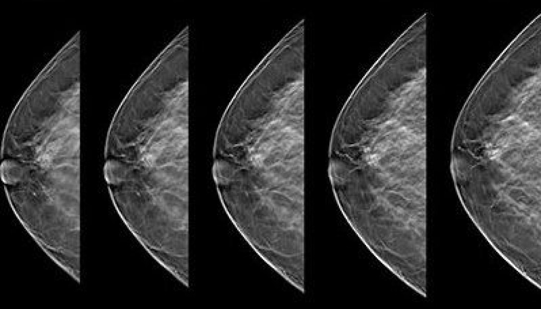 Tomosyntese gir mer detaljerte bilder enn ved tradisjonell mammografi og er derfor mer effektivt til å påvise kreftsvulster. (Foto: Kreftregisteret) Tomosyntese gir mer detaljerte bilder enn ved tradisjonell mammografi og er derfor mer effektivt til å påvise kreftsvulster. (Foto: Kreftregisteret)