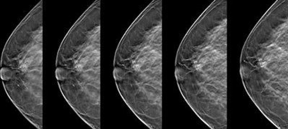 Tomosyntese gir mer detaljerte bilder enn ved tradisjonell mammografi og er derfor mer effektivt til å påvise kreftsvulster.  (Foto: Kreftregisteret)