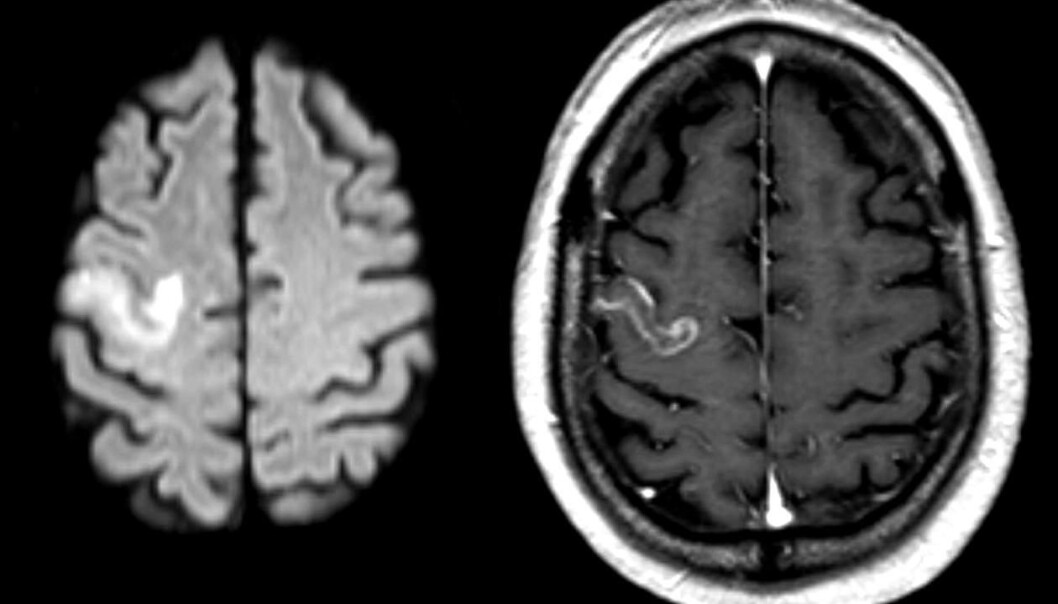 A new method analysis promises better treatment for stroke patients with language problems in the future. (Photo: Wikimedia Commons/Hellerhoff) A new method analysis promises better treatment for stroke patients with language problems in the future. (Photo: Wikimedia Commons/Hellerhoff)