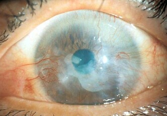 Using cells from the mouth to cure blindness