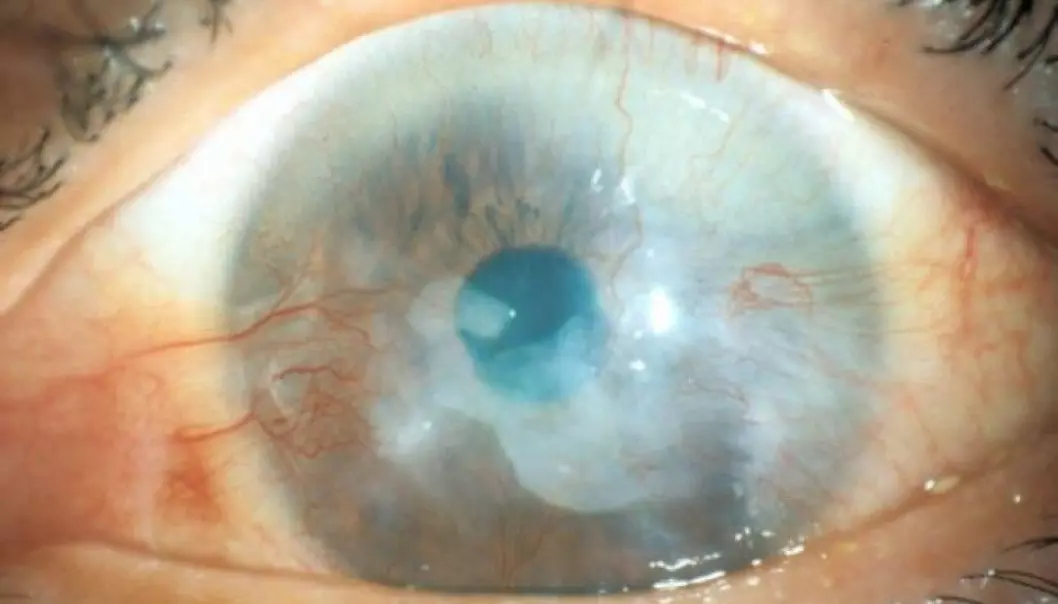 Eyes that suffer mildly from limbal stem cell definciancy. The stem cells stall and other cells grow over the cornea. The window of the eye, normally clear and transparent, is thus blurred, leading to reduced vision. (Photo: Dr. Takahiro Nakamura, Department of Ophtalmology, Kyoto Prefectural University of Medicine)