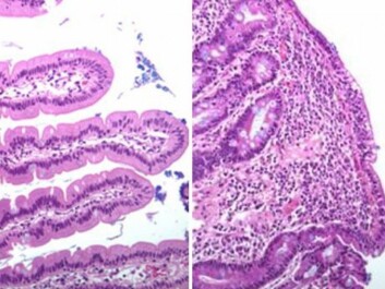 Left: Healthy duodenum. Right: Duodenum showing villi damaged by coeliac disease. (Photo: University of Oslo) Left: Healthy duodenum. Right: Duodenum showing villi damaged by coeliac disease. (Photo: University of Oslo)