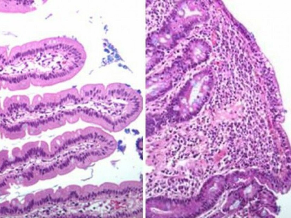 Left: Healthy duodenum. Right: Duodenum showing villi damaged by coeliac disease. (Photo: University of Oslo)