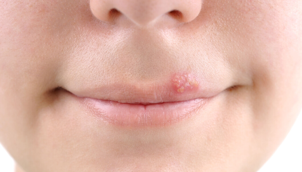 Verdens helseorganisasjon anslår at over halvparten av verdens befolkning under 50 år er smittet av herpes. (Illustrasjonsfoto: Microstock) Verdens helseorganisasjon anslår at over halvparten av verdens befolkning under 50 år er smittet av herpes. (Illustrasjonsfoto: Microstock)
