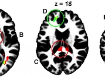 Local differences in white matter are evident between high and low risk-takers as illustrated by the coloured areas adjacent to the prefrontal cortex, within interhemispheric tracts, and in the rear of the brain that controls vision. (Illustration: Sintef) Local differences in white matter are evident between high and low risk-takers as illustrated by the coloured areas adjacent to the prefrontal cortex, within interhemispheric tracts, and in the rear of the brain that controls vision. (Illustration: Sintef)