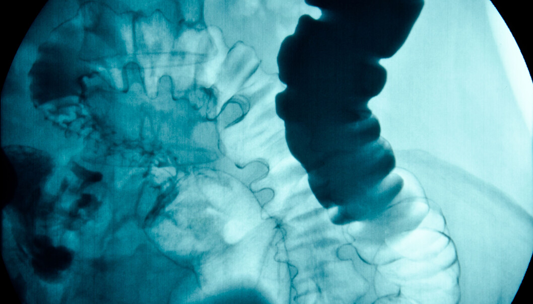 Ved tarmkreft er det viktig med en god tidlig diagnose. Norge ligger bare midt på treet når det gjelder nedgang i dødelighet av sykdommen de siste 40 årene. Her ser du et røtngenbilde av en mage. (Foto: Microstock) Ved tarmkreft er det viktig med en god tidlig diagnose. Norge ligger bare midt på treet når det gjelder nedgang i dødelighet av sykdommen de siste 40 årene. Her ser du et røtngenbilde av en mage. (Foto: Microstock)