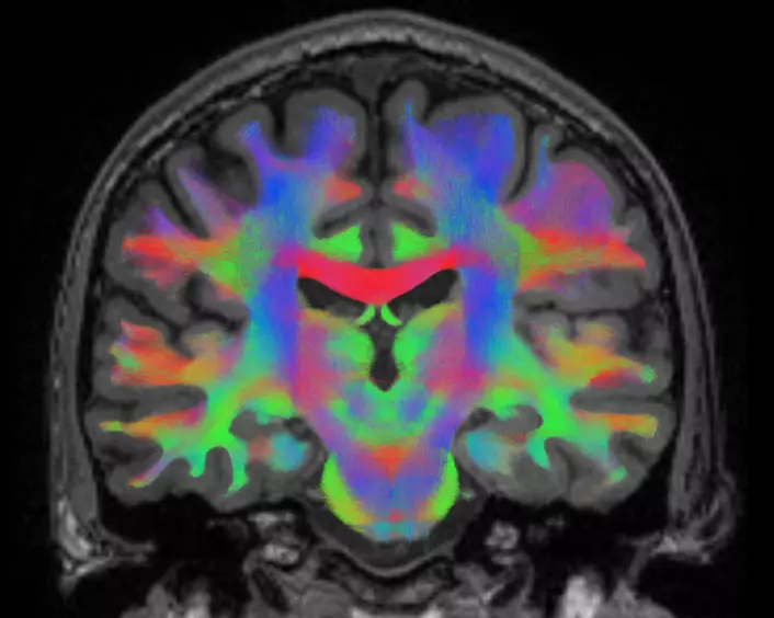 Ulike typer forbindelser og områder i hjernen sett i en MRI-scan. Forskningsprosjektet Brain-DTI skal scanne hjernen til romfarere for å se hvordan hjernen tilpasser seg livet i rommet. (Foto: Universitet i Antwerpen)