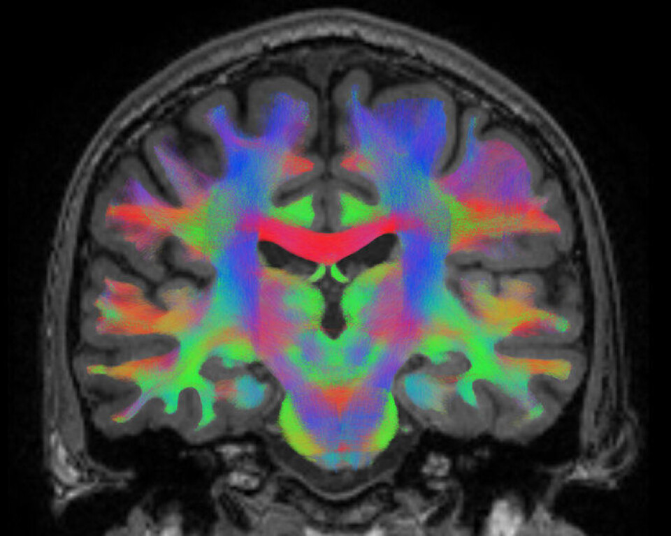 Ulike typer forbindelser og områder i hjernen sett i en MRI-scan. Forskningsprosjektet Brain-DTI skal scanne hjernen til romfarere for å se hvordan hjernen tilpasser seg livet i rommet. (Foto: Universitet i Antwerpen)