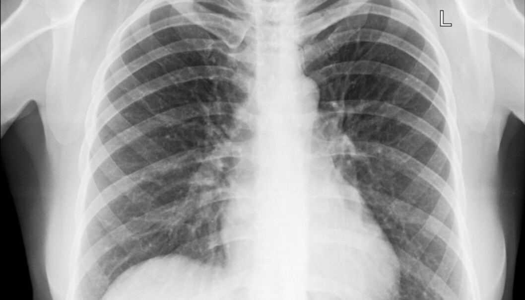 Cecilie Svanes has found that the aging of the lungs is influenced by factors early in life, such as the time you were born.(Illustrative photo: Colourbox.) Cecilie Svanes has found that the aging of the lungs is influenced by factors early in life, such as the time you were born.(Illustrative photo: Colourbox.)