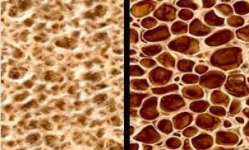Bildet viser normalt beinvev og beinvev med osteoporose. (Foto: Foto fra CCM Melbourne)) Bildet viser normalt beinvev og beinvev med osteoporose. (Foto: Foto fra CCM Melbourne))