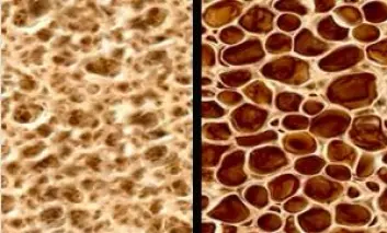 Bildet viser normalt beinvev og beinvev med osteoporose.  (Foto: Foto fra CCM Melbourne))