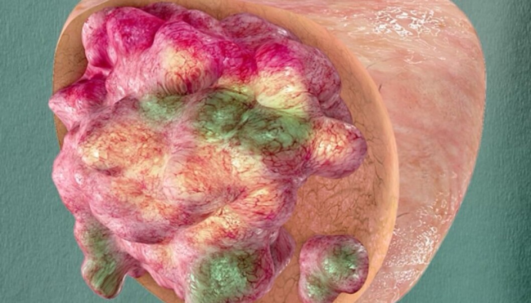 When a doctor takes a tissue sample from a tumor in order to diagnose cancer, they only take out a very small part. However, this can give a false picture of how serious the state of the patient really is. This is because a tumor consists of a range of different cancer cells. This image shows the degree of variations in a prostate tumor. (Illustration: Oslo University Hospital) When a doctor takes a tissue sample from a tumor in order to diagnose cancer, they only take out a very small part. However, this can give a false picture of how serious the state of the patient really is. This is because a tumor consists of a range of different cancer cells. This image shows the degree of variations in a prostate tumor. (Illustration: Oslo University Hospital)