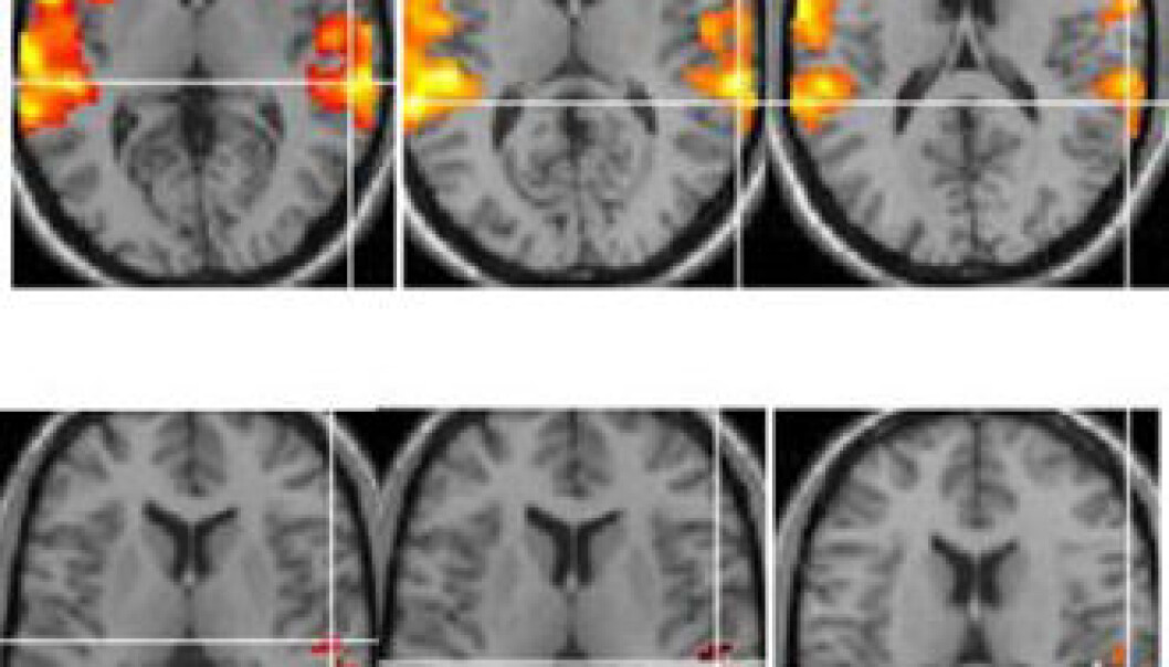 Image captures of the brain show how neurons are activated in healthy control subjects when hearing actual voices (top row) whereas activation fails to occur in patients who experience auditory hallucinations. (Photo: Kenneth Hugdahl) Image captures of the brain show how neurons are activated in healthy control subjects when hearing actual voices (top row) whereas activation fails to occur in patients who experience auditory hallucinations. (Photo: Kenneth Hugdahl)