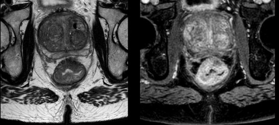 Bildet viser en pasient med tarmkreft som er med på studien. Nederst på bildet er rompeballene, mens klumpen rett over rumpa er en kreftsvulst i endetarmen. Forskerne håper de kan gi bedre behandling ved å kunne 'kikke' inn i svulsten. (Foto: OxyTarget-studien)
