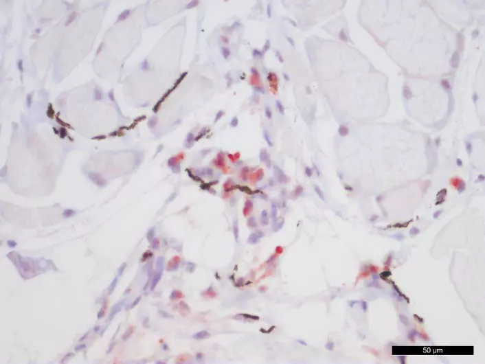 Mikroskopisk bilde fra melaninflekk. Røde celler viser tilstedeværelse av virus og mørke celler er melananomakrofager som gir opphav til den mørke misfargingen i fileten. (Foto: (Bilde: NMBU))
