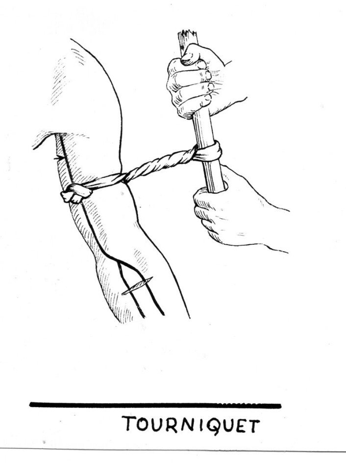 En gammeldags tourniquet. Et pinne brukes for å stramme båndet rundt armen. (Foto: (Illustrasjon: Pearson Scott Foresman-arkivene)) En gammeldags tourniquet. Et pinne brukes for å stramme båndet rundt armen. (Foto: (Illustrasjon: Pearson Scott Foresman-arkivene))