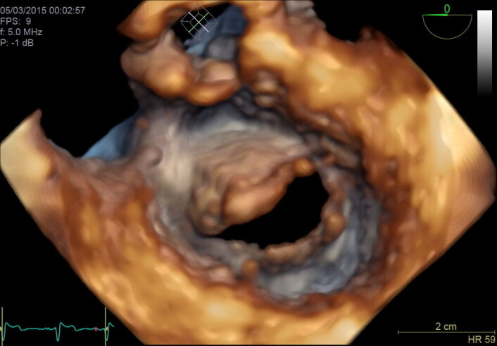 3D-bilde av hjerteklaff tatt med spiserørssonde under en operasjon. (Foto: (Illustrasjon: GE Vingmed Ultrasound)) 3D-bilde av hjerteklaff tatt med spiserørssonde under en operasjon. (Foto: (Illustrasjon: GE Vingmed Ultrasound))