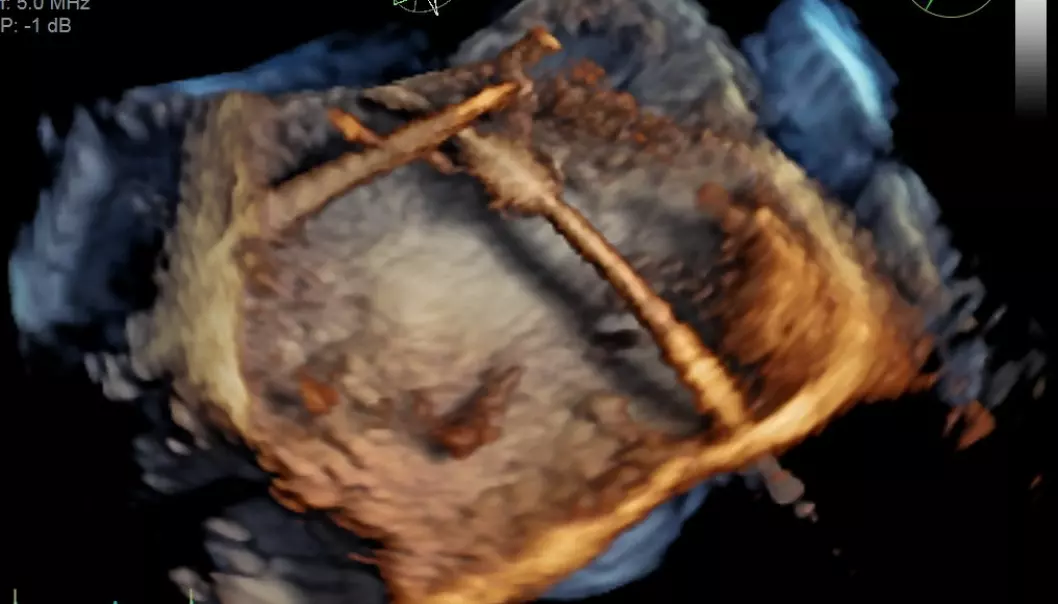 Ny ultralydteknologi kan gi bedre bilder av hjertet