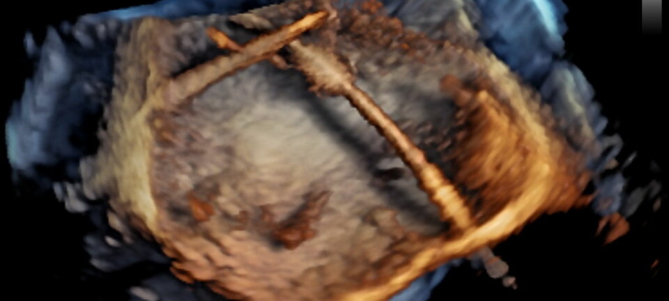 3D-bilder tatt med spiserørssonde kan brukes for eksempel under kirurgiske inngrep i hjertet, som på dette bildet. Strukturen som du ser midt i bildet, skal festes i hjertet til en pasient.  (Illustrasjon: GE Vingmed Ultrasound)