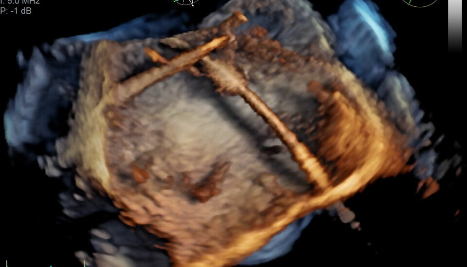 3D-bilder tatt med spiserørssonde kan brukes for eksempel under kirurgiske inngrep i hjertet, som på dette bildet. Strukturen som du ser midt i bildet, skal festes i hjertet til en pasient.  (Illustrasjon: GE Vingmed Ultrasound)