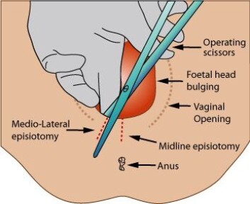 Illustrasjon av en mediolateral episiotomi, hvor man klipper til siden, i stedet for rett ned. (Foto: (Illustrasjonsbilde: Jeremy kemp/Wikimedia commons)) Illustrasjon av en mediolateral episiotomi, hvor man klipper til siden, i stedet for rett ned. (Foto: (Illustrasjonsbilde: Jeremy kemp/Wikimedia commons))