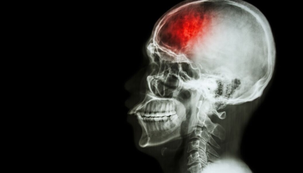 Ved å lære mer om FSAP-genet tror forskere man kan finne nye måter å behandle slag og infarkt på. (Foto: Colourbox) Ved å lære mer om FSAP-genet tror forskere man kan finne nye måter å behandle slag og infarkt på. (Foto: Colourbox)