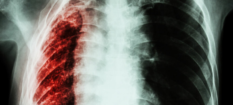 Tuberkulose tar 4000 liv hver dag. (Foto: Colourbox)