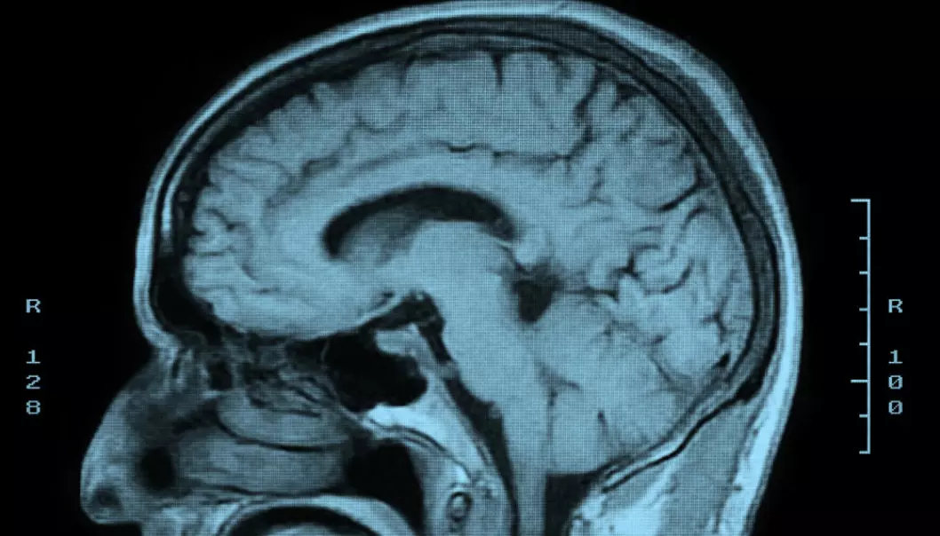 MRI-skanning av en hjerne. Forskerne fant endringer i volumet av hvit substans og grå materie i ulike deler av hjernen hos deltakere som hadde fått hodeskader etter ulykker eller overfall. Endringene tilsvarte flere års aldring. (Foto: Microstock)