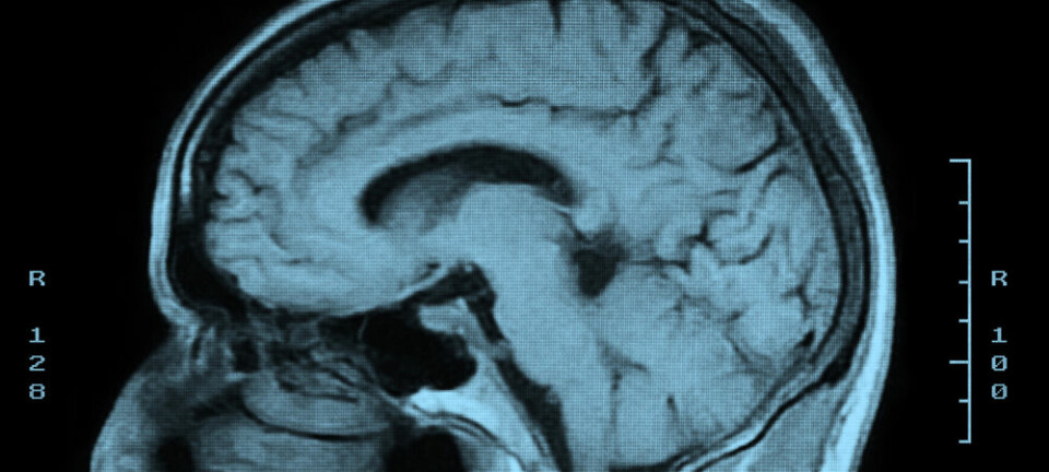 MRI-skanning av en hjerne. Forskerne fant endringer i volumet av hvit substans og grå materie i ulike deler av hjernen hos deltakere som hadde fått hodeskader etter ulykker eller overfall. Endringene tilsvarte flere års aldring. (Foto: Microstock)