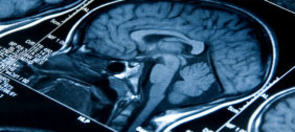 MRI-skanning av en hjerne. Forskerne fant endringer i volumet av hvit substans og grå materie i ulike deler av hjernen hos deltakere som hadde fått hodeskader etter ulykker eller overfall. Endringene tilsvarte flere års aldring.  (Illustrasjonsfoto: iStockphoto)